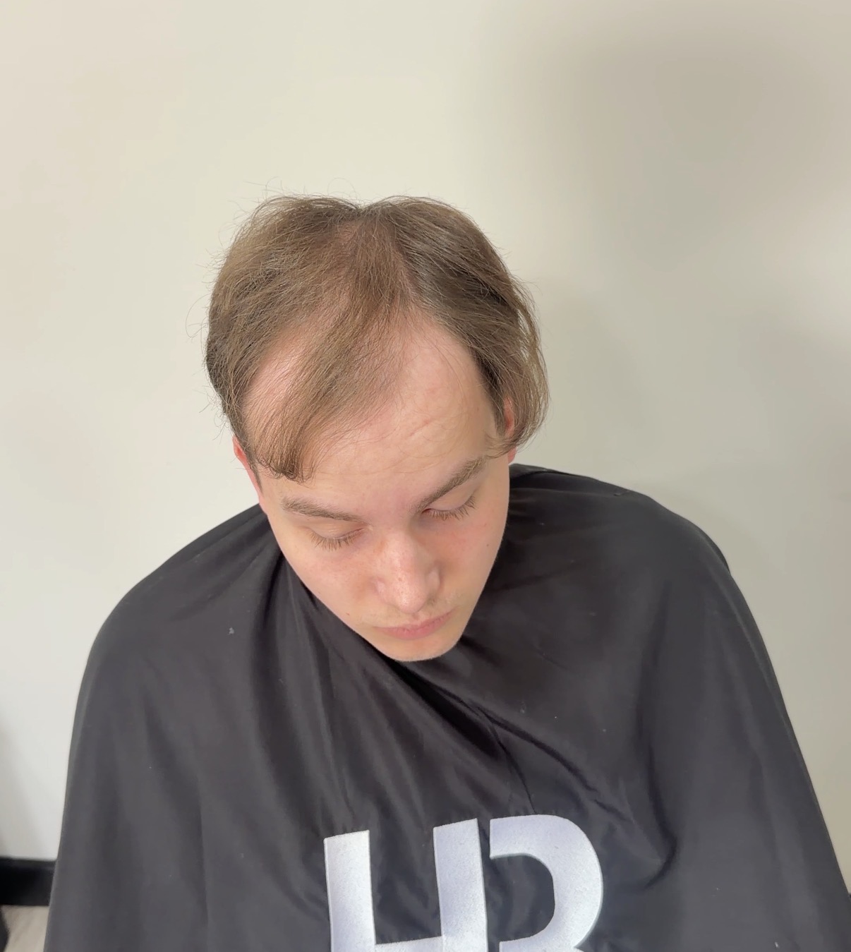 Client before hair replacement