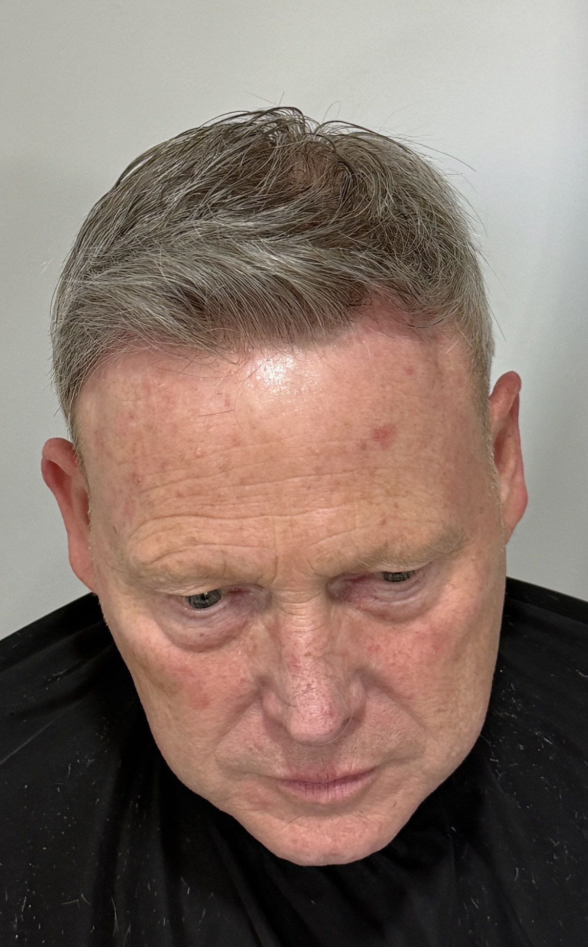 Ultra-realistic hair replacement result showing natural hair movement and styling